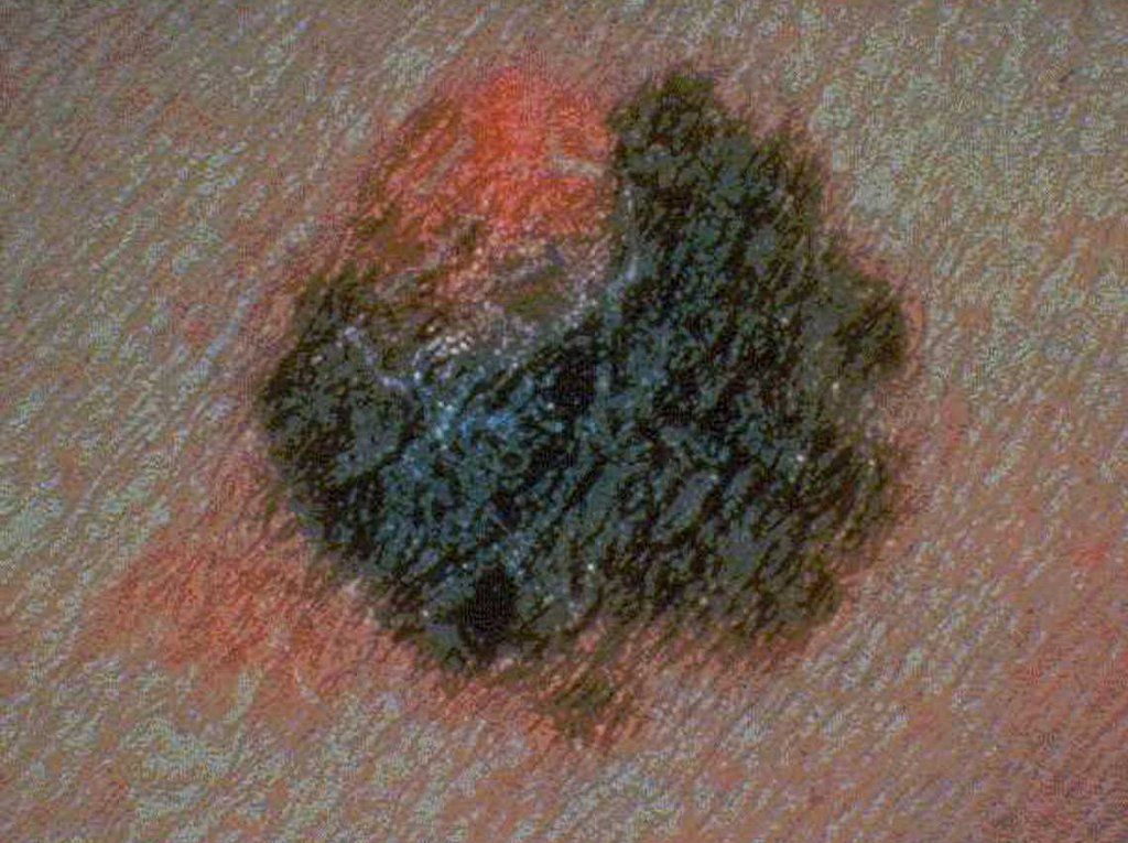 Melanoma, a deadly skin cancer, can begin as a new small, pigmented skin growth on normal skin as shown in this undated photo. Unlike other forms of skin cancer, melanoma readily spreads to different parts of the body, where it continues to grow and destroy tissue. (KEYSTONE/AP Photo/The American Cancer Society)   ===  ===