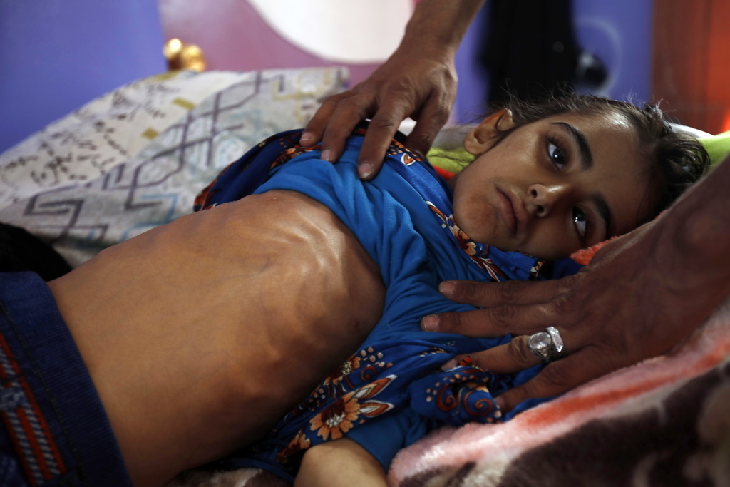 Les conflits, comme ici au Yémen, aggrave la malnutrition des populations civiles.