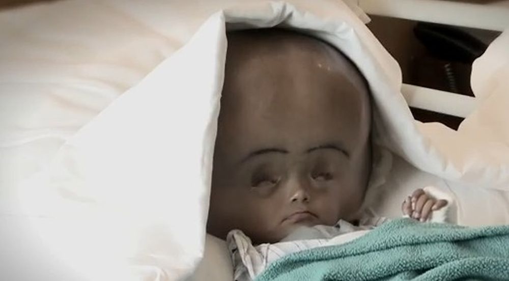 Roona Begum,  âgée de 17 mois, est née avec une grave anomalie neurologique.