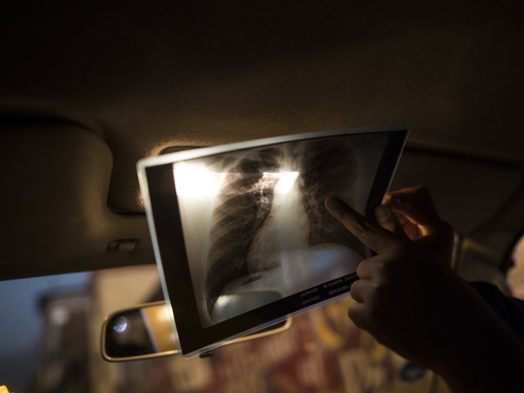 Une radiographie montre les poumons d’un malade originaire du Venezuela, éclairée par le plafonnier d’une voiture au Pérou (archives).