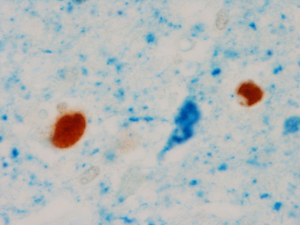 This undated image provided by the Mayo Clinic shows an abnormal TDP-43, the two circular brown blobs, in the brain of a patient with tau neurofibrillary tangle, blue flame shape blob in the middle, and Alzheimer?s disease during the pathological analyses in Rochester, Minn. Scientists have linked a new protein to Alzheimer's disease, different from the amyloid and tau that make up the sticky brain plaques and tangles long known to be its hallmarks and was discussed Wednesday, July 16, 2014, at the Alzheimer's Association International Conference in Copenhagen. (AP Photo/Mayo Clinic)