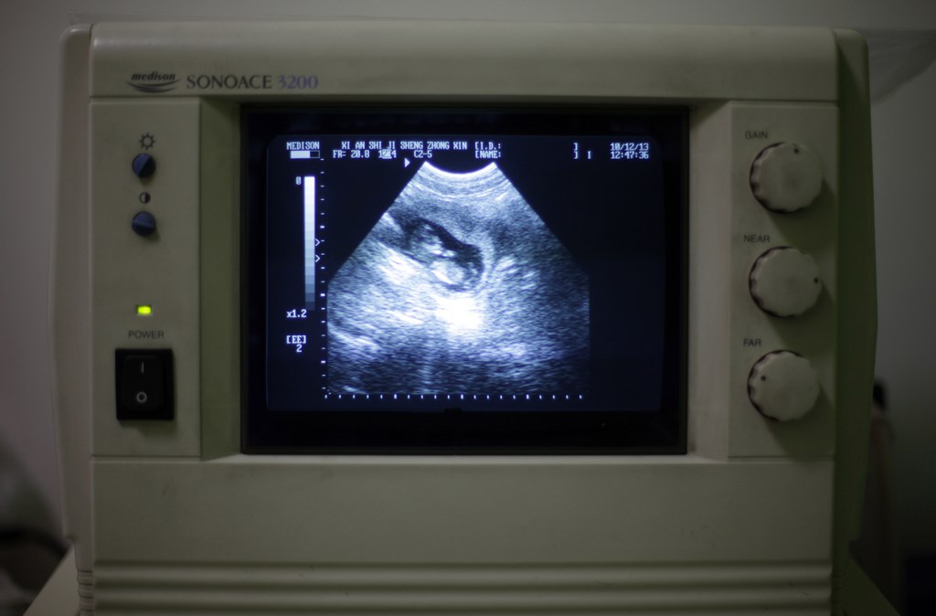 This photo taken Monday, Dec. 13, 2010 shows an image of a three-month-old fetus during a sonogram scan for "Nancy" Yin at a clinic run by Marie Stopes International in Xi'an in central China's Shaanxi province. (AP Photo/Ng Han Guan)
