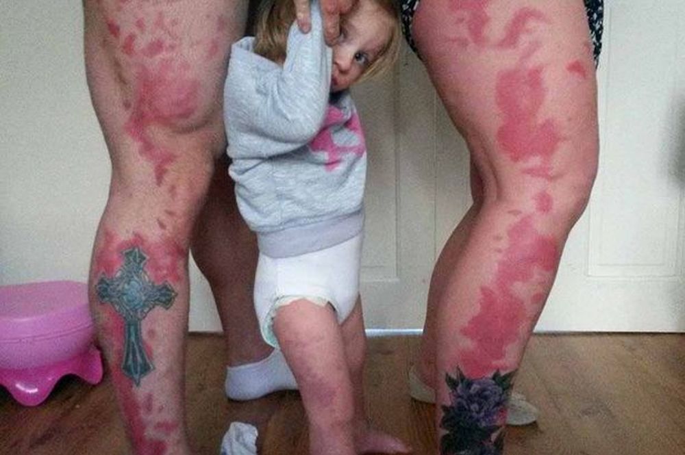 Les parents de Honey-Rea se sont fait tatouer une reproduction des taches de naissance de leur fille.