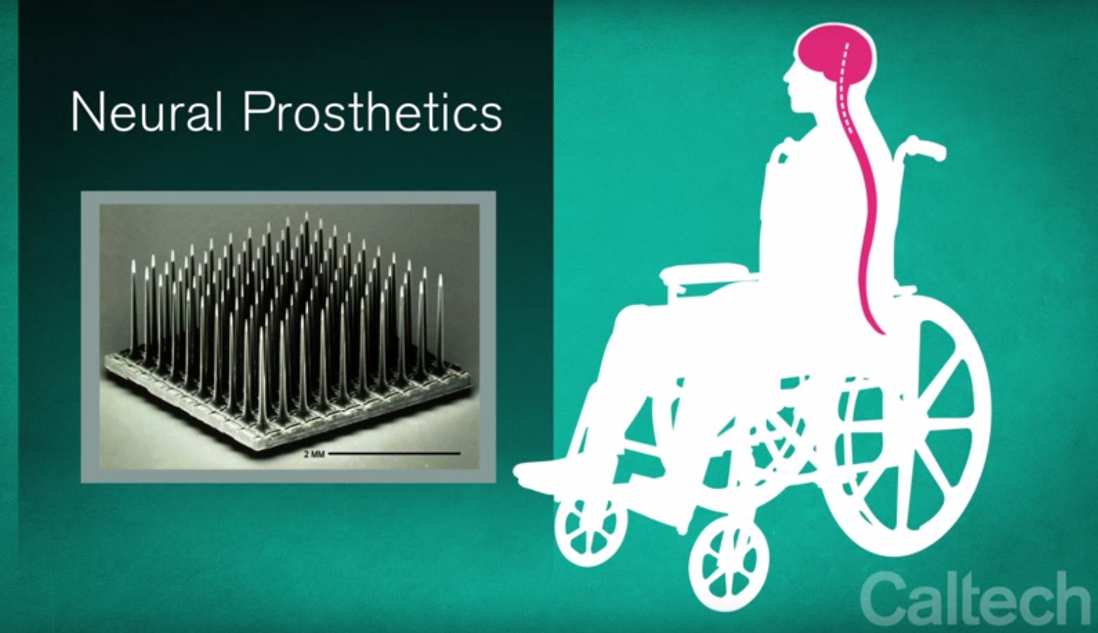 C'est grâce à une minuscule prothèse implantée directement dans le cerveau, que le patient peut faire bouger son bras.