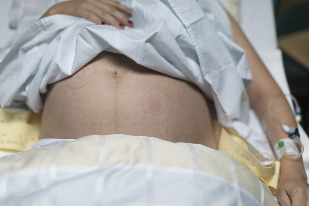 La fillette, un peu forte, ne s'était pas aperçue qu'elle était enceinte de 32 semaines. Elle est allée à l'hôpital pour des douleurs abdominales.