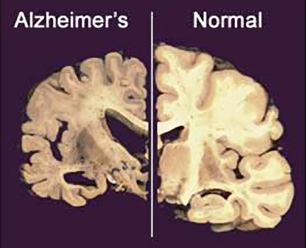 Les Noirs américains sont plus souvent atteints de la forme tardive d'Alzheimer que les Blancs.